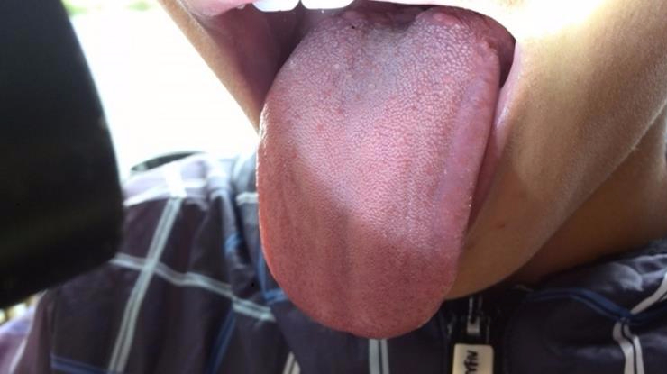 太可怕了!舌头上出现这种东西竟是艾滋病早期症状,看看你有吗?